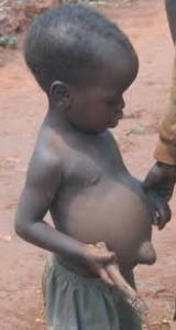 A child suffering from Kwashiorkor